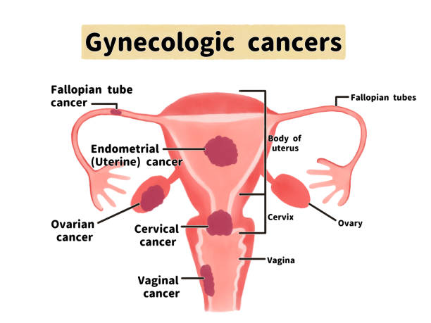 Best Gynecologic Cancer Specialist in Thane